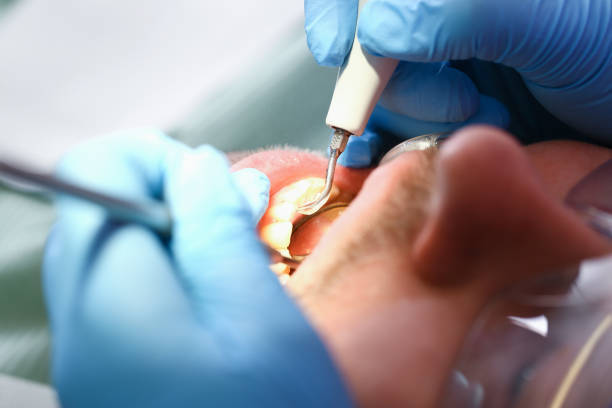 Best Dentist for Tooth Abscess  in Blue Rapids, KS